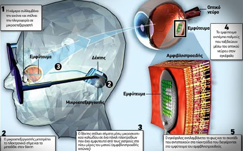 Η λειτουργεία του βιονικού ματιού
